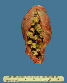 gallstones and liver detoxification