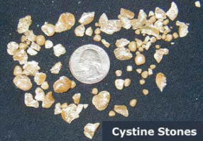 Cystine stones compared to quarter
