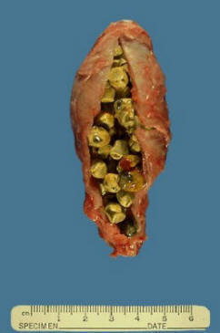 Liver cleanse, gallbladder cleanse, hepatic bile ducts cleanse, Gallstones flush, avoid surgery 