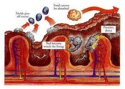 Cross section of intestinal wall, bowel cleanse, dirty sick bowel before bowel cleanse, bentonite,psyllium